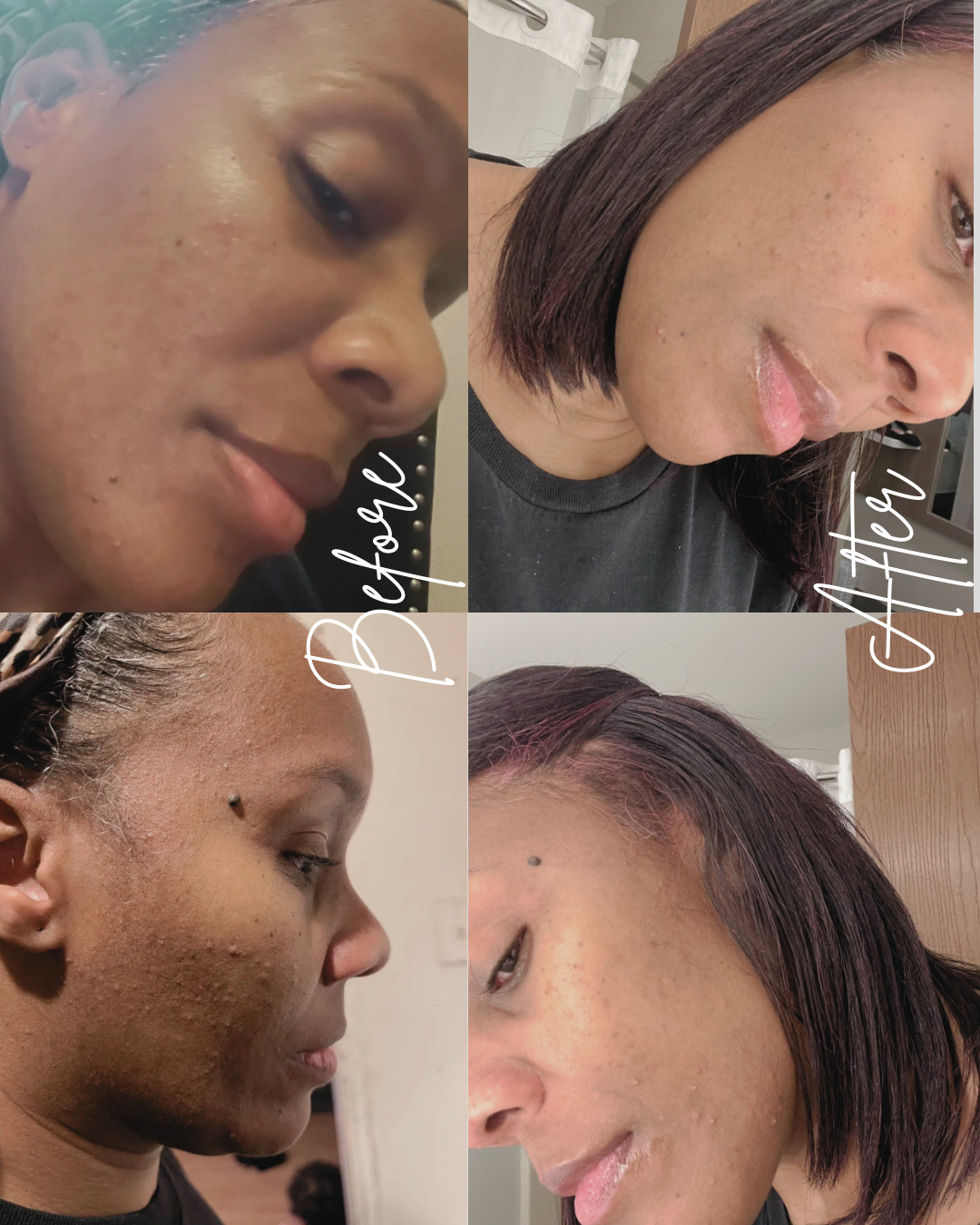 Aqua's Custom Acne + Glow Routine Bundle